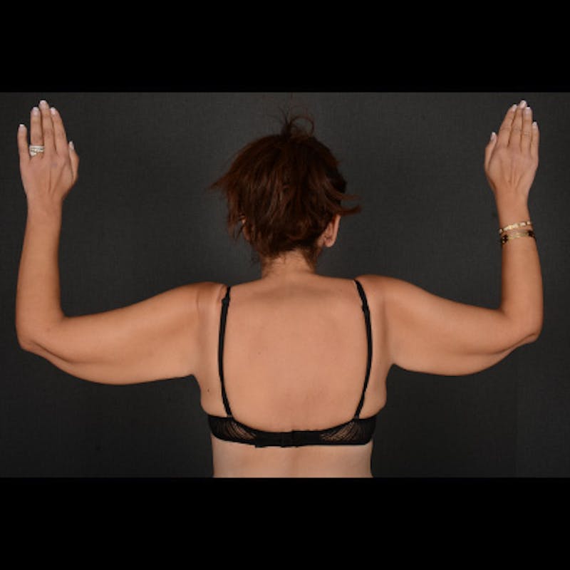 Arm Lift Before & After Gallery - Patient 120781 - Image 1