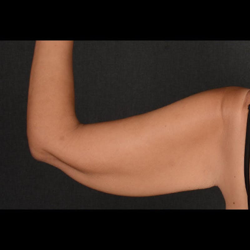Arm Lift Before & After Gallery - Patient 120781 - Image 5
