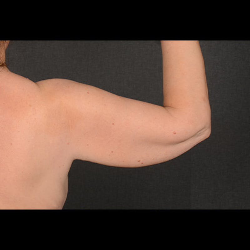 Arm Lift Before & After Gallery - Patient 327729 - Image 3