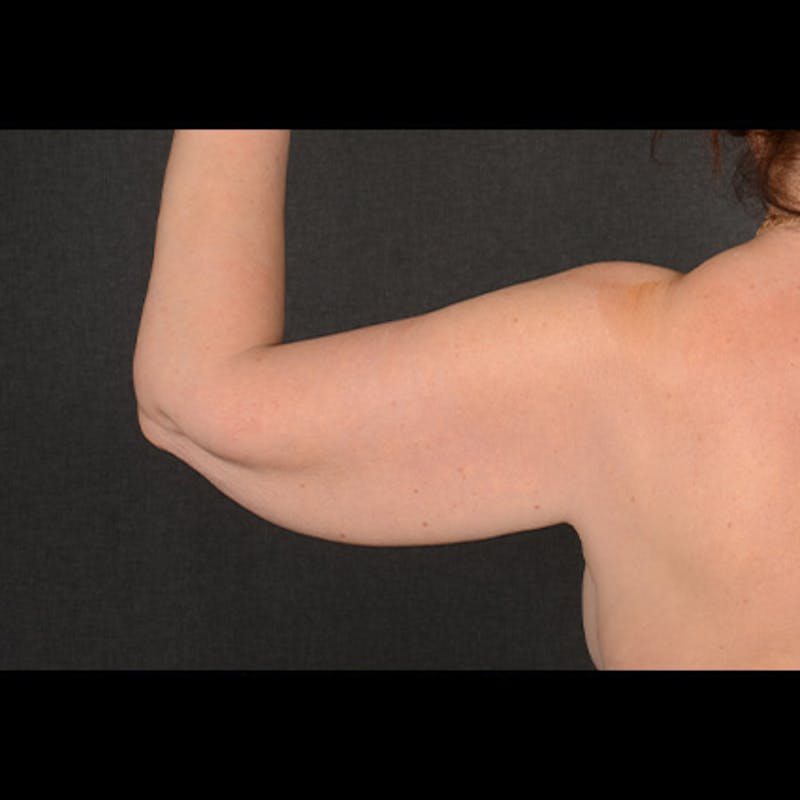 Arm Lift Before & After Gallery - Patient 327729 - Image 5