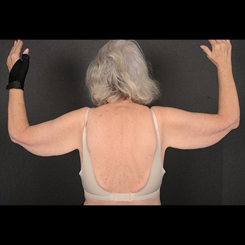 Arm Lift Before & After Gallery - Patient 419482 - Image 1