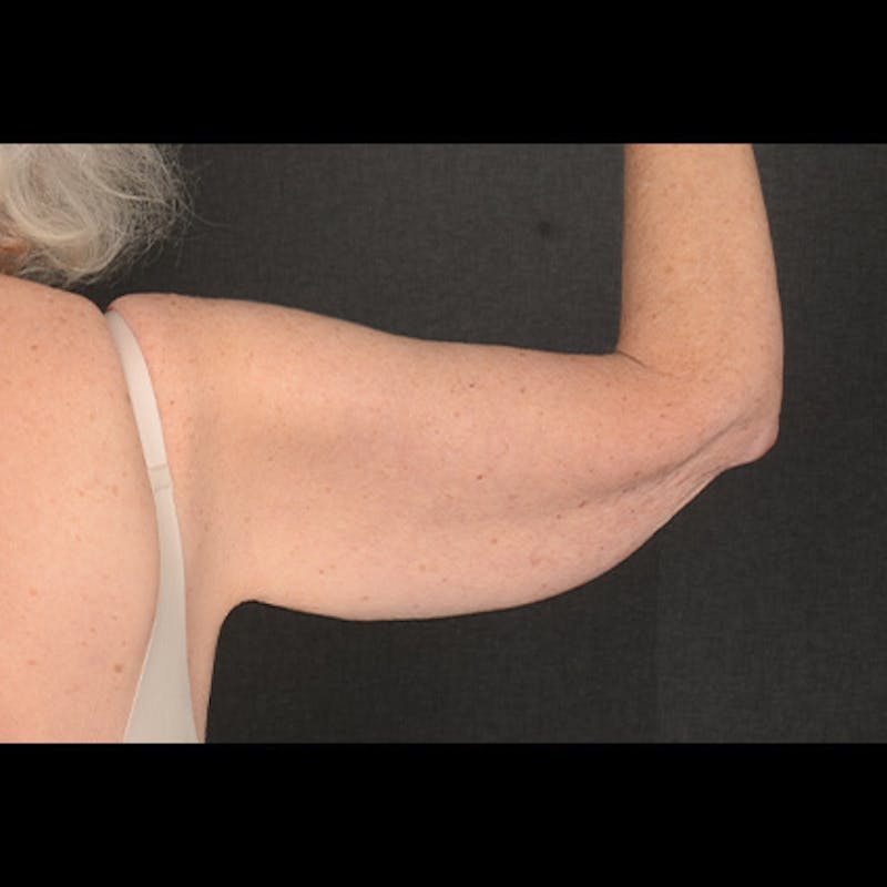 Arm Lift Before & After Gallery - Patient 419482 - Image 3
