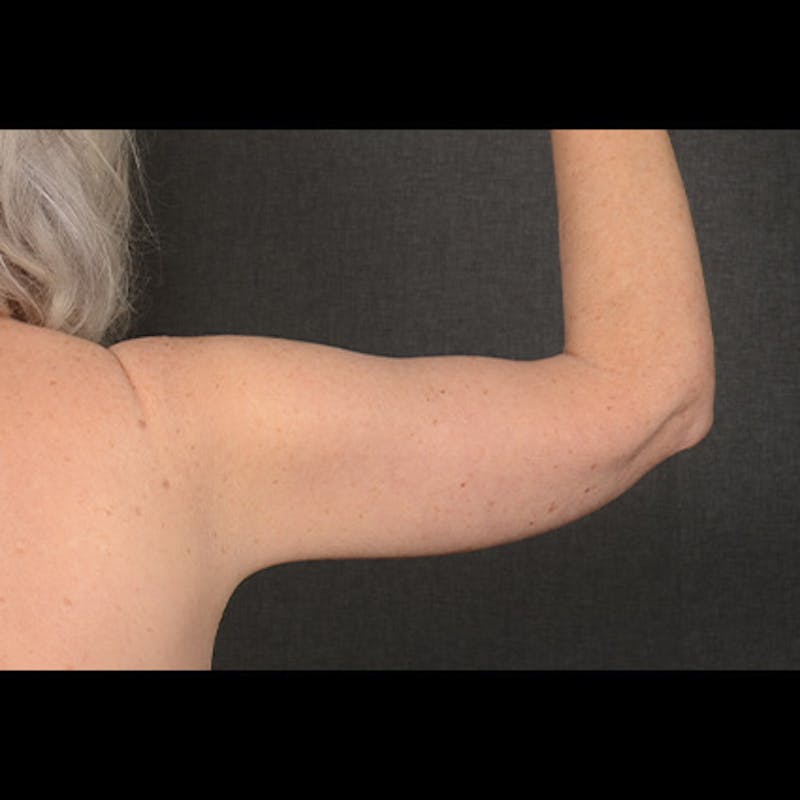 Arm Lift Before & After Gallery - Patient 419482 - Image 4