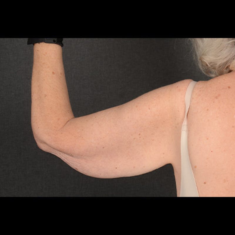 Arm Lift Before & After Gallery - Patient 419482 - Image 5