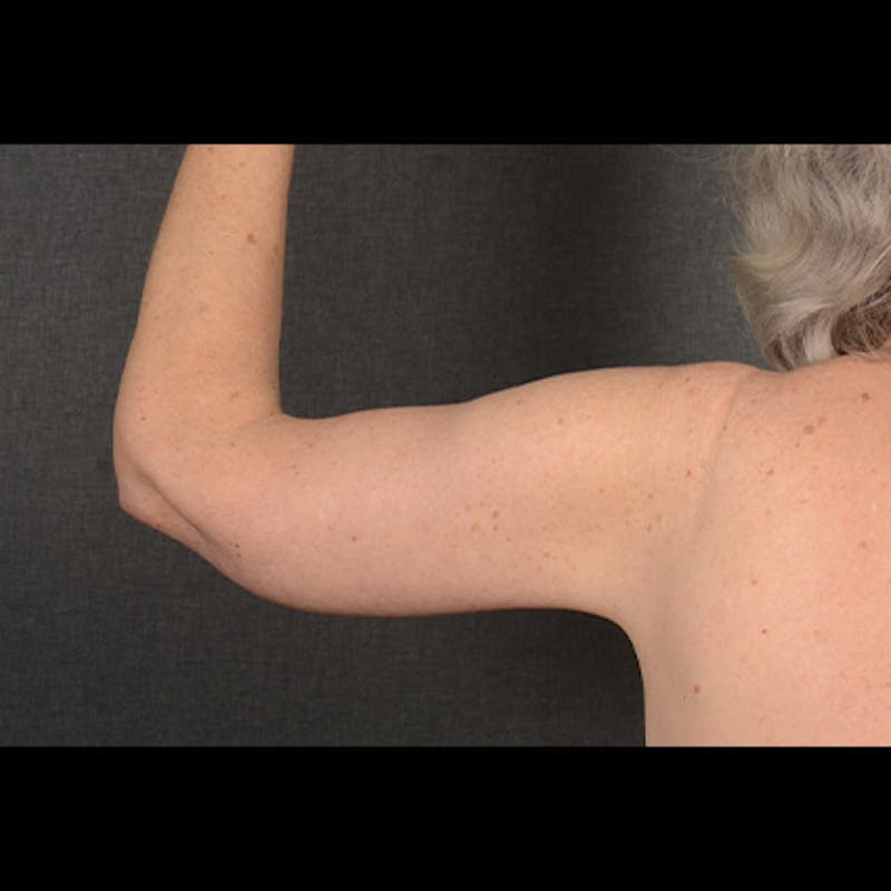 Arm Lift Before & After Gallery - Patient 419482 - Image 6