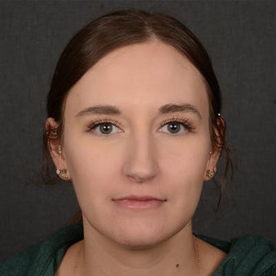 Female Rhinoplasty Before & After Gallery - Patient 118820 - Image 1