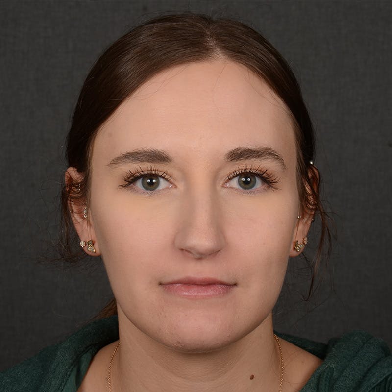 Female Rhinoplasty Before & After Gallery - Patient 118820 - Image 1