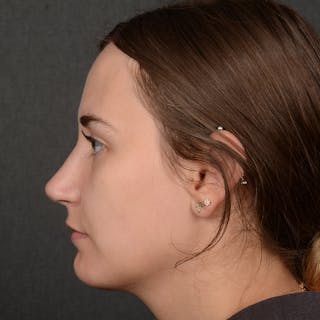 Female Rhinoplasty Before & After Gallery - Patient 118820 - Image 4