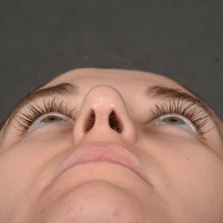 Female Rhinoplasty Before & After Gallery - Patient 118820 - Image 8