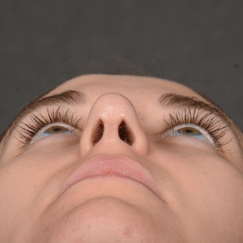 Female Rhinoplasty Before & After Gallery - Patient 118820 - Image 5