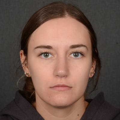 Female Rhinoplasty Before & After Gallery - Patient 118820 - Image 2