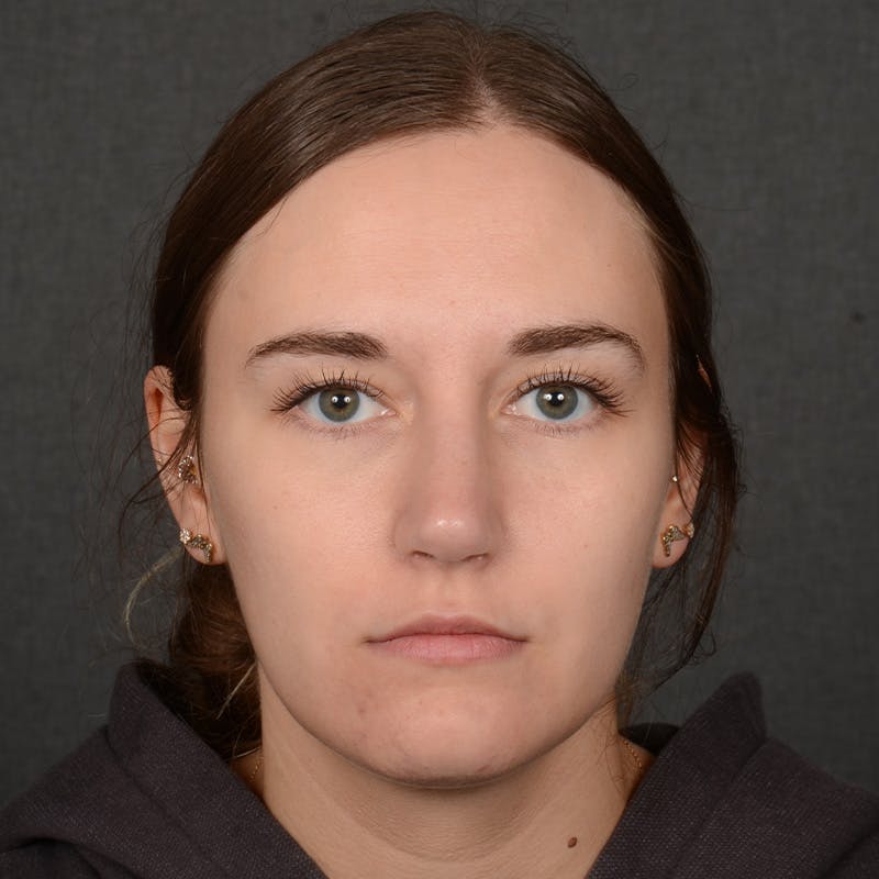 Female Rhinoplasty Before & After Gallery - Patient 118820 - Image 8
