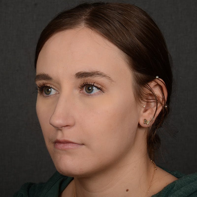 Female Rhinoplasty Before & After Gallery - Patient 118820 - Image 2