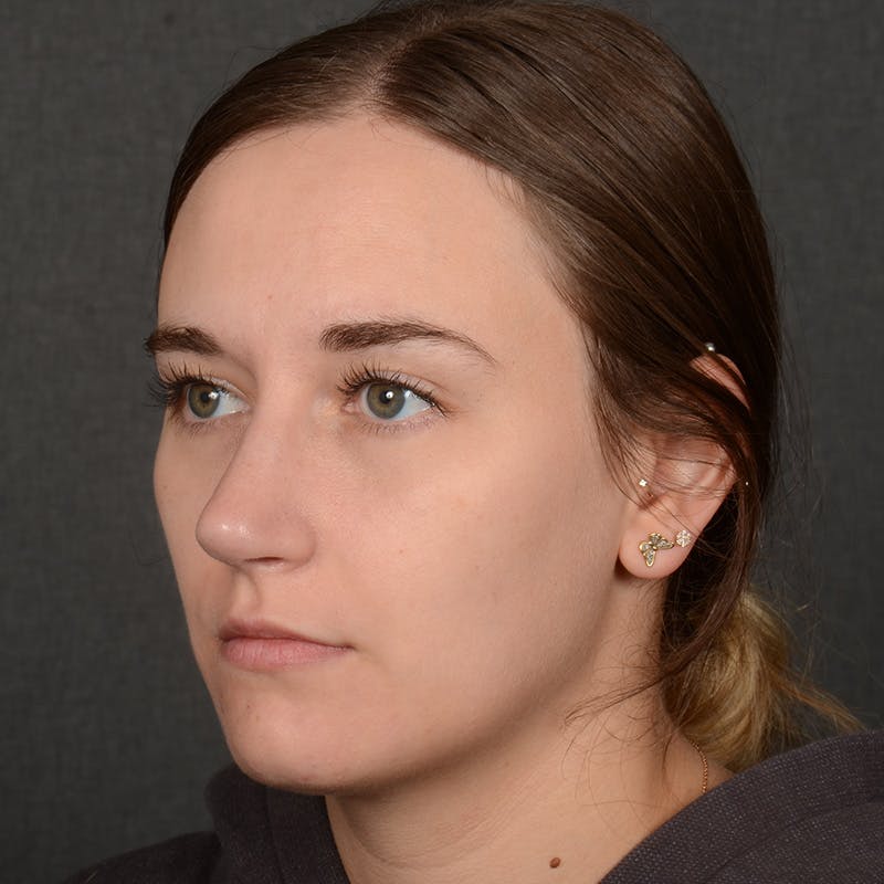 Female Rhinoplasty Before & After Gallery - Patient 118820 - Image 6