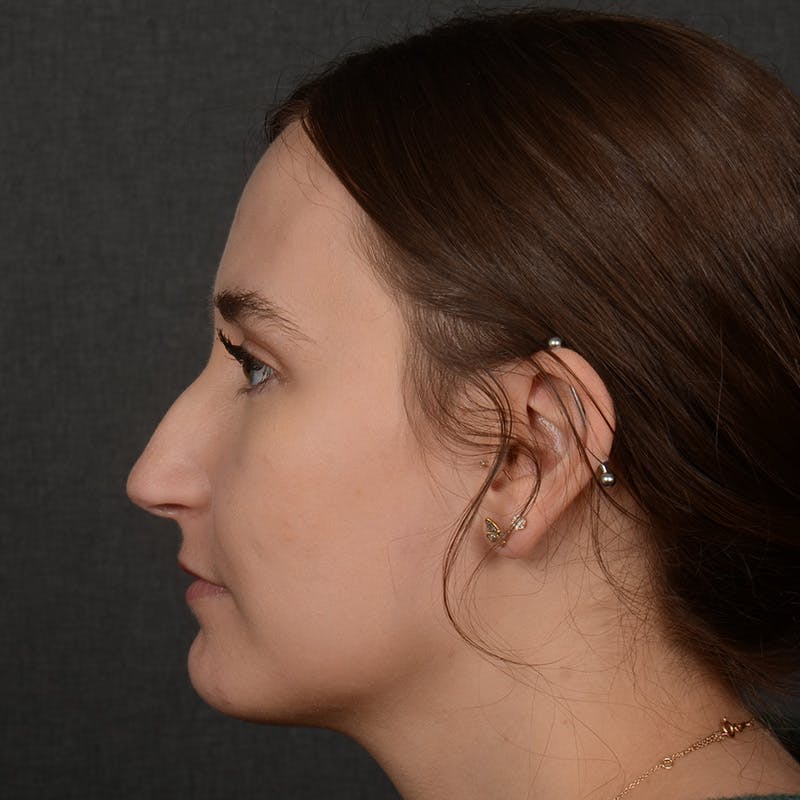 Female Rhinoplasty Before & After Gallery - Patient 118820 - Image 3