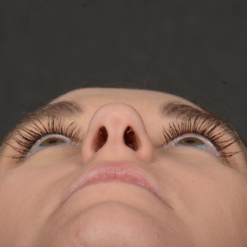 Female Rhinoplasty Before & After Gallery - Patient 118820 - Image 7