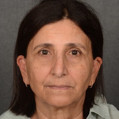 Female Rhinoplasty Before & After Gallery - Patient 699357 - Image 2