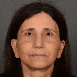 Female Rhinoplasty Before & After Gallery - Patient 699357 - Image 2