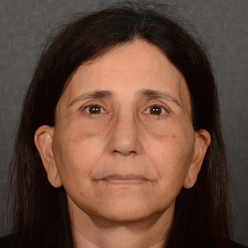 Female Rhinoplasty Before & After Gallery - Patient 699357 - Image 1