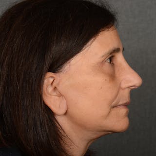 Female Rhinoplasty Before & After Gallery - Patient 699357 - Image 6