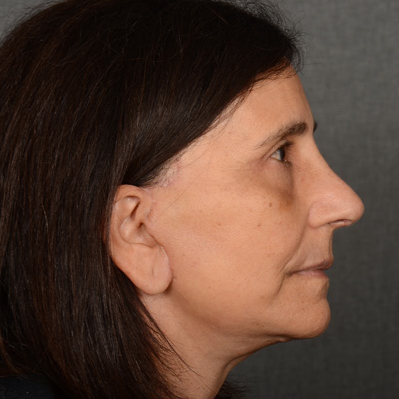 Female Rhinoplasty Before & After Gallery - Patient 699357 - Image 5