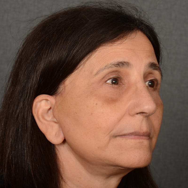 Female Rhinoplasty Before & After Gallery - Patient 699357 - Image 3