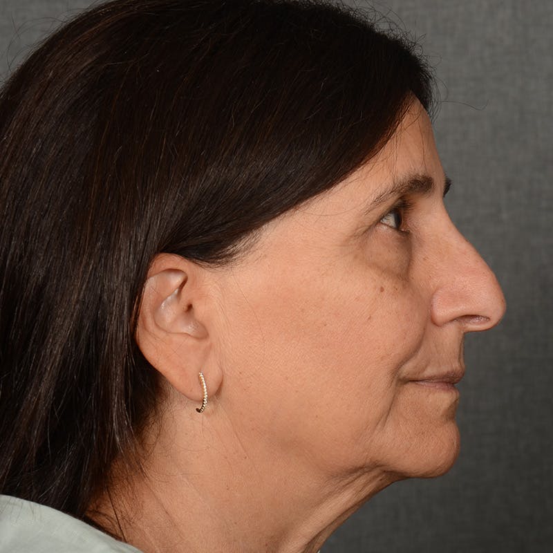 Female Rhinoplasty Before & After Gallery - Patient 699357 - Image 6