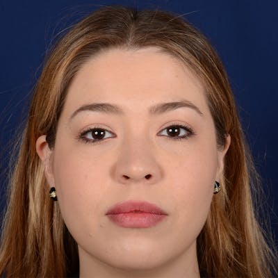 Female Rhinoplasty Before & After Gallery - Patient 297275 - Image 1