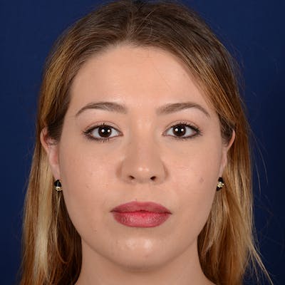 Female Rhinoplasty Before & After Gallery - Patient 297275 - Image 2