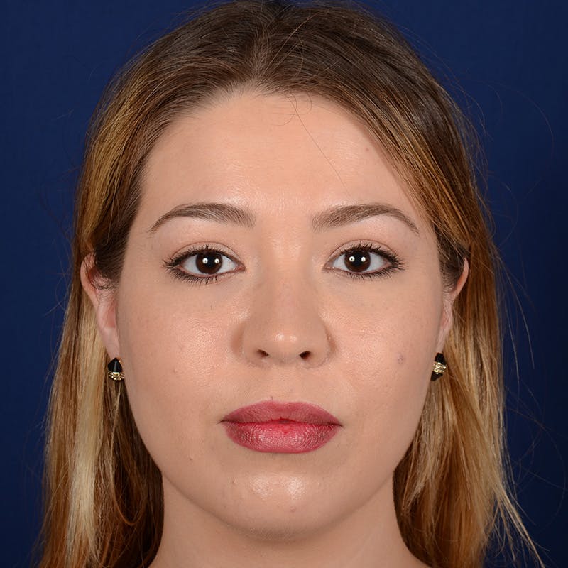 Female Rhinoplasty Before & After Gallery - Patient 297275 - Image 2