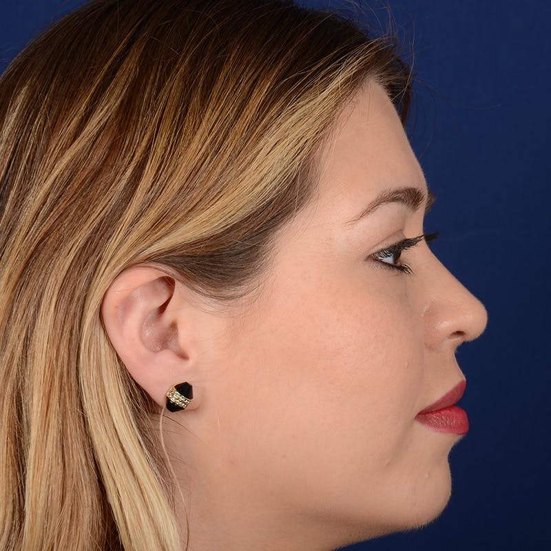 Female Rhinoplasty Before & After Gallery - Patient 297275 - Image 5