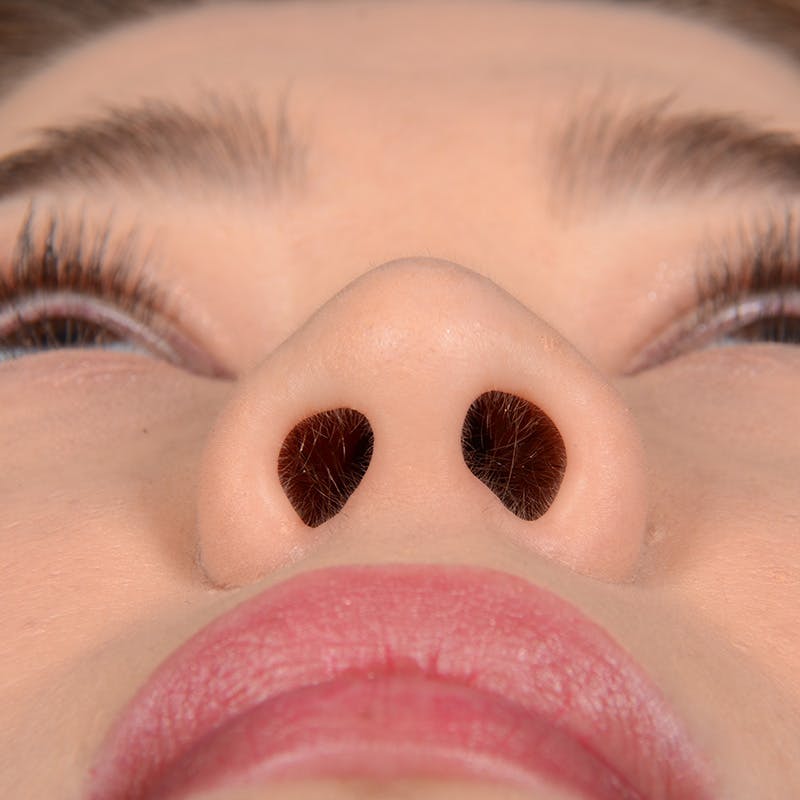 Female Rhinoplasty Before & After Gallery - Patient 297275 - Image 8