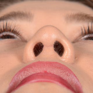 Female Rhinoplasty Before & After Gallery - Patient 297275 - Image 8
