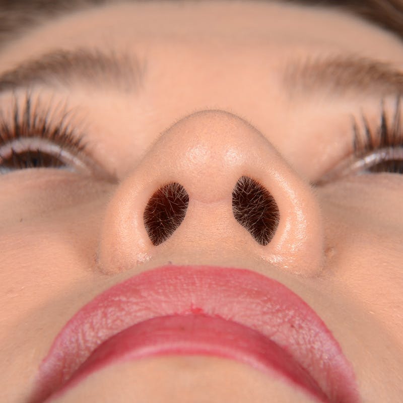 Female Rhinoplasty Before & After Gallery - Patient 297275 - Image 7