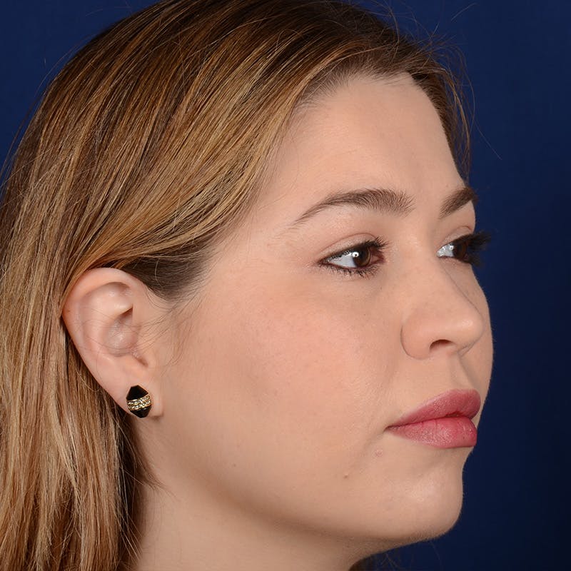 Female Rhinoplasty Before & After Gallery - Patient 297275 - Image 3