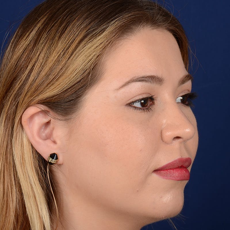 Female Rhinoplasty Before & After Gallery - Patient 297275 - Image 4