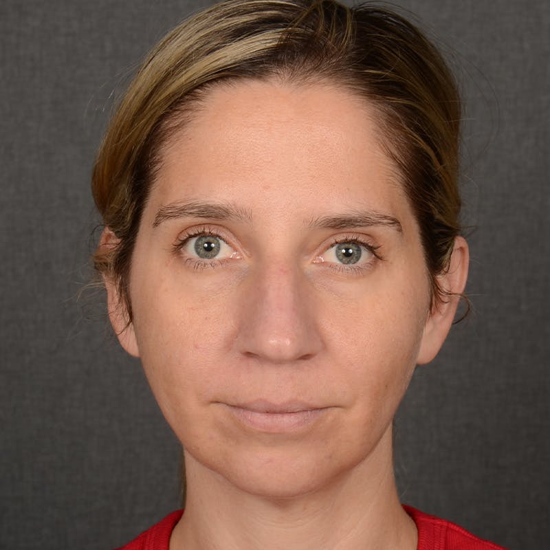 Female Rhinoplasty Before & After Gallery - Patient 187357 - Image 1