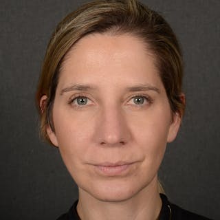 Female Rhinoplasty Before & After Gallery - Patient 187357 - Image 2