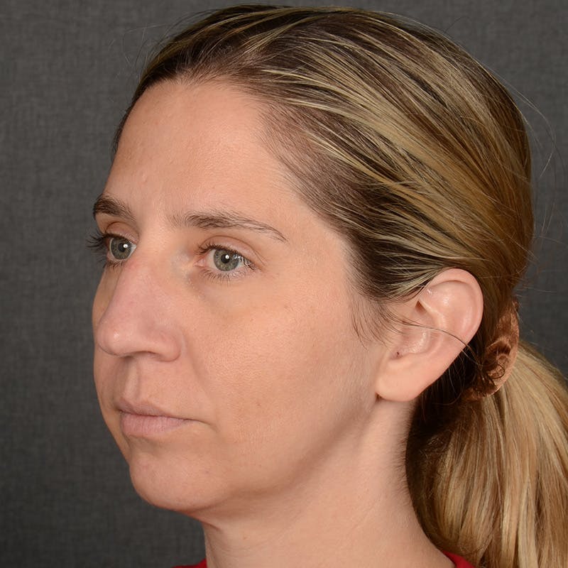 Female Rhinoplasty Before & After Gallery - Patient 187357 - Image 3