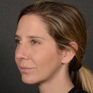 Female Rhinoplasty Before & After Gallery - Patient 187357 - Image 4