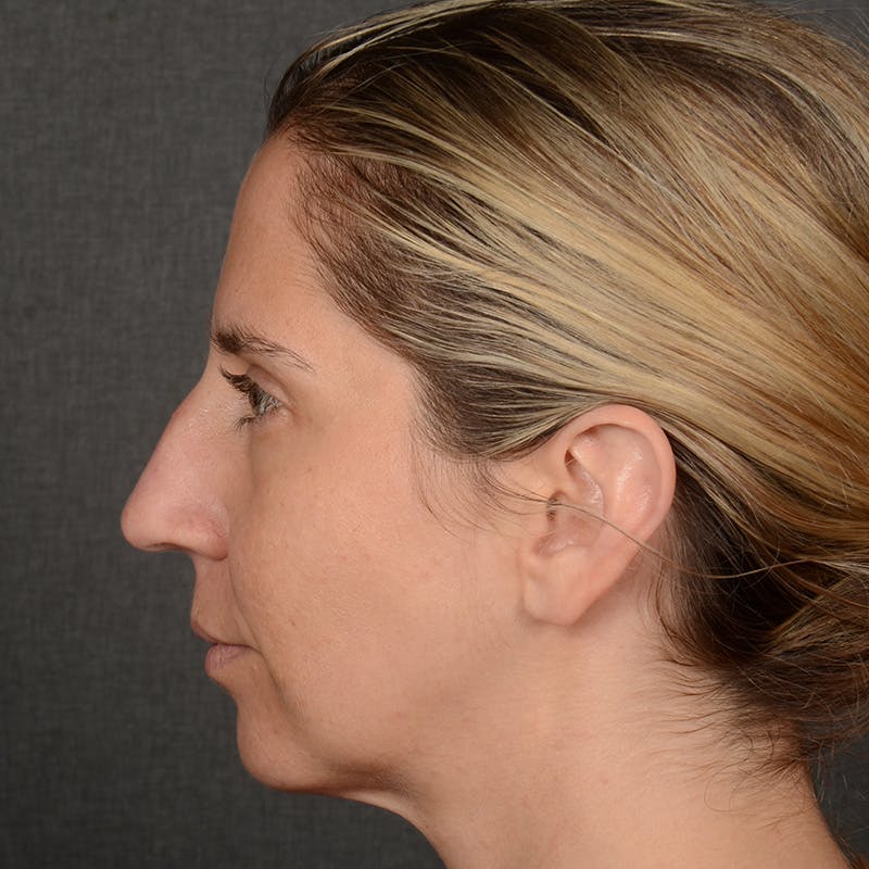 Female Rhinoplasty Before & After Gallery - Patient 187357 - Image 5