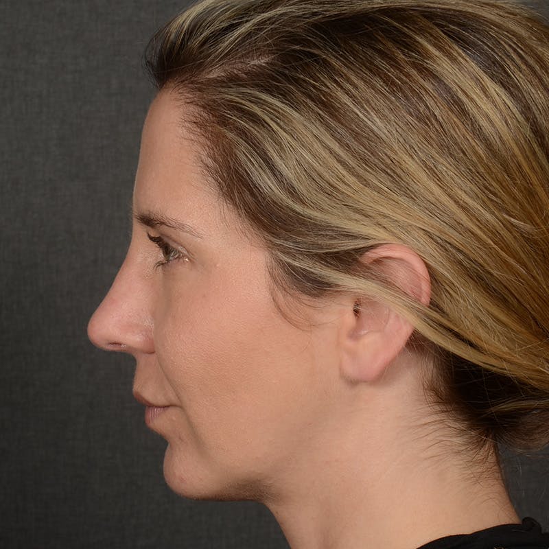 Female Rhinoplasty Before & After Gallery - Patient 187357 - Image 6