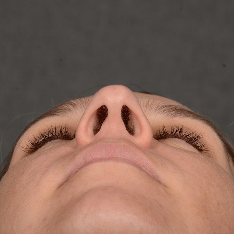 Female Rhinoplasty Before & After Gallery - Patient 187357 - Image 7
