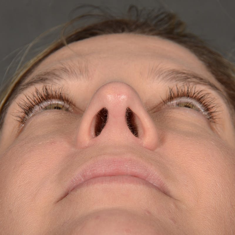 Female Rhinoplasty Before & After Gallery - Patient 187357 - Image 8