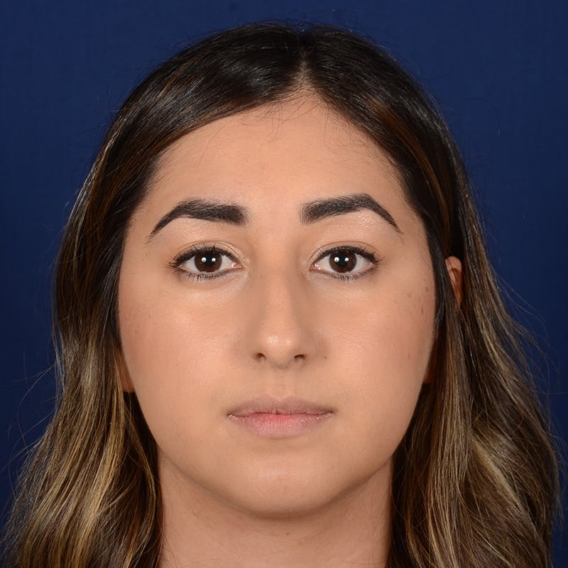 Female Rhinoplasty Before & After Gallery - Patient 378721 - Image 1