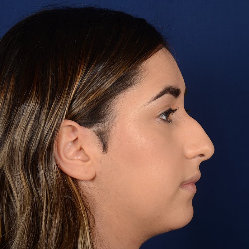 Female Rhinoplasty Before & After Gallery - Patient 378721 - Image 5