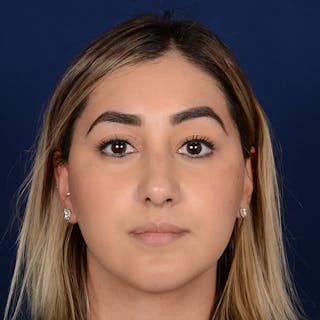 Female Rhinoplasty Before & After Gallery - Patient 378721 - Image 2