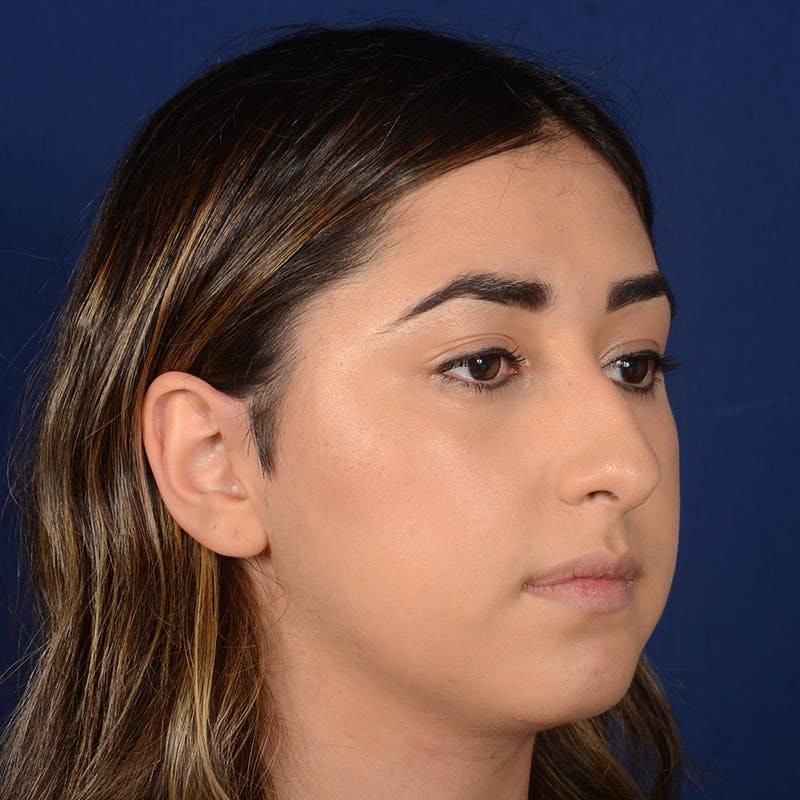 Female Rhinoplasty Before & After Gallery - Patient 378721 - Image 3