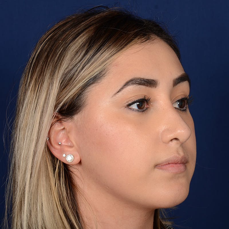 Female Rhinoplasty Before & After Gallery - Patient 378721 - Image 4