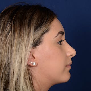 Female Rhinoplasty Before & After Gallery - Patient 378721 - Image 6